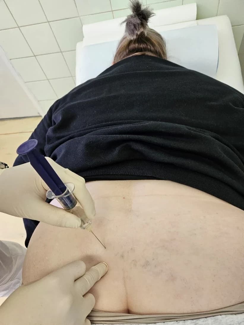 Pacijentica leži na trbuhu, u slabinskom dijelu leđa paravertebralno je uvedena igla sa štrcaljkom.