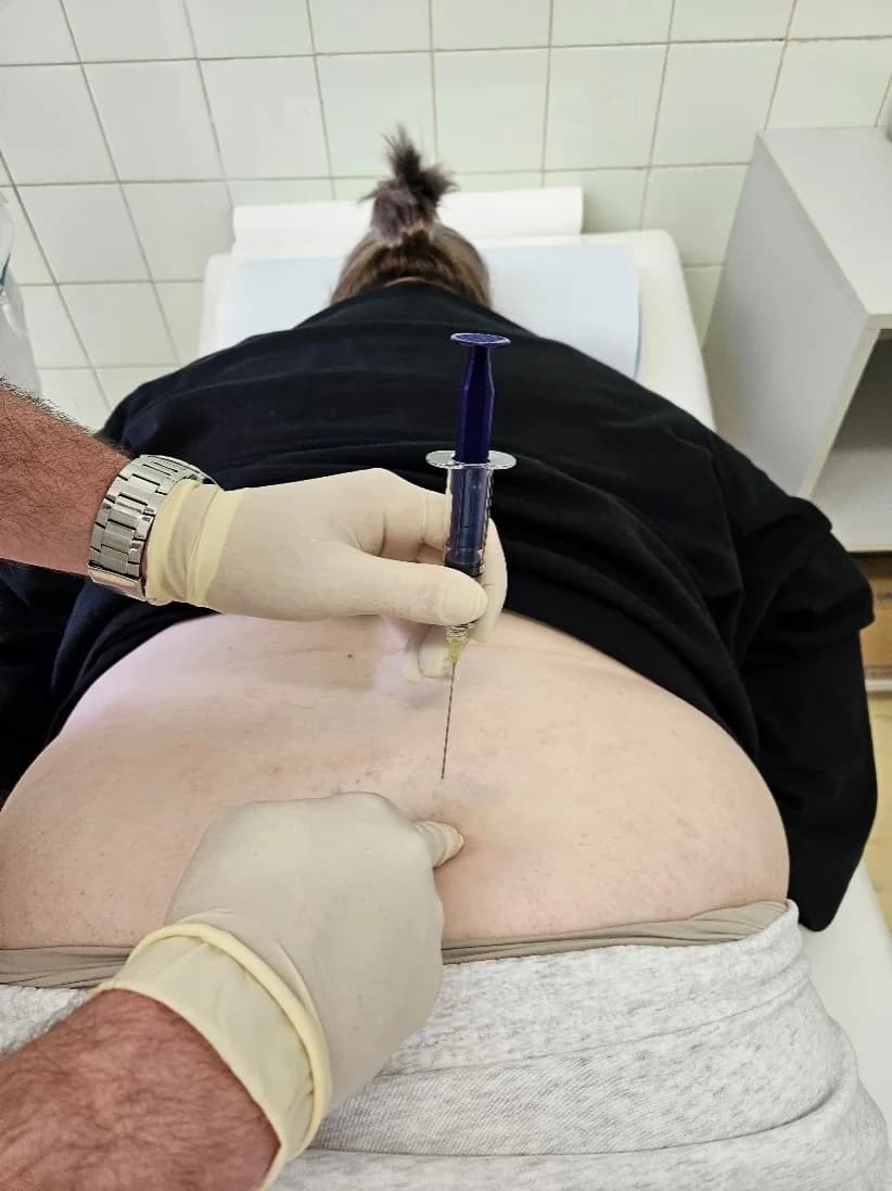 Štrcaljka držana okomito na kožu, igla uvedena paravertebralno u slabinskom području.