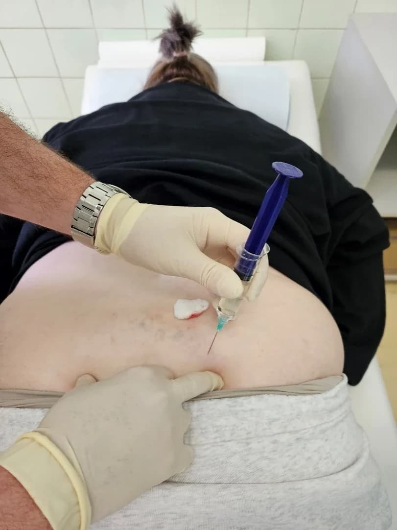 Igla sa štrcaljkom na mjestu uboda, pokraj nje tupfer položen na kožu.
