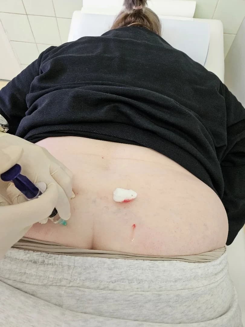Slabinski dio leđa nakon primjene, na koži tupfer i kap krvi na mjestu uboda.