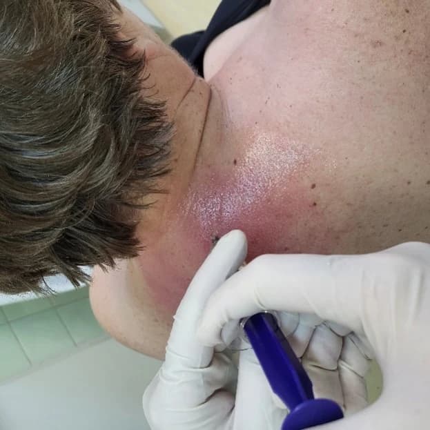 Ruka u jednokratnoj rukavici drži štrcaljku tijekom primjene u područje vratne kralježnice; pacijentica leži s glavom okrenutom od objektiva.