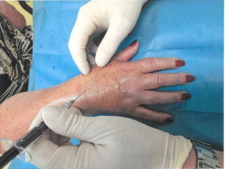 Injekcija u desni ručni zglob pacijentice pri drugoj primjeni.